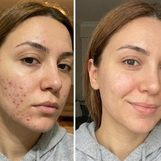 Zerdeçal İçeren Nazik Peeling Pedleri  & Cildiniz Parlasın