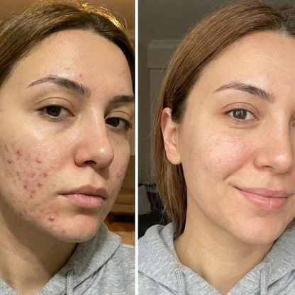 Zerdeçal İçeren Nazik Peeling Pedleri  & Cildiniz Parlasın